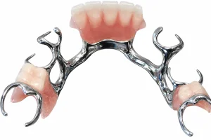 A chrome partial denture with spaces for remaining natural teeth